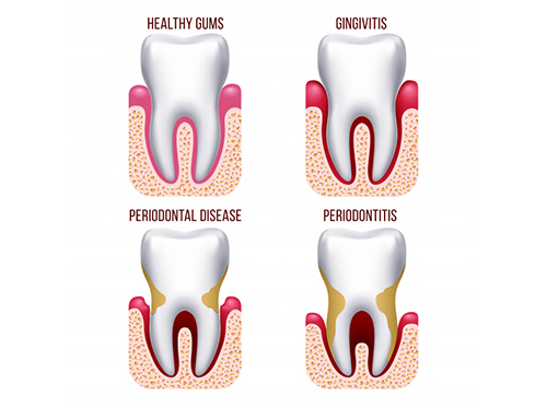 Should I Get Root Planing and Scaling (“deep cleaning”) from the General  Dentist or Periodontist?: Willow Glen Dental Specialists: Periodontists